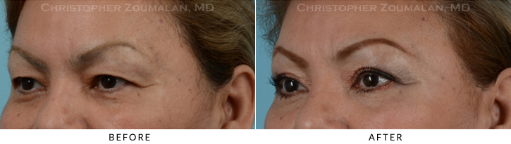 Upper Lid Blepharoplasty Before & After Photo - Patient Seeing Side - Patient 32C