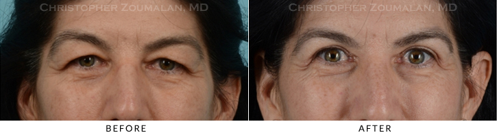Upper Lid Blepharoplasty Before & After Photo - Patient Seeing Straight - Patient 34A