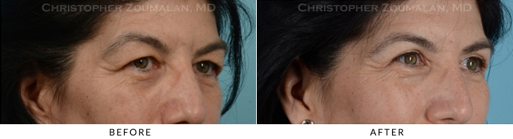 Upper Lid Blepharoplasty Before & After Photo -  - Patient 34B