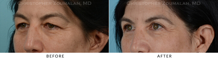 Upper Lid Blepharoplasty Before & After Photo - Patient Seeing Side - Patient 34C