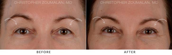 Upper Lid Blepharoplasty Before & After Photo - Patient Seeing Straight - Patient 17A