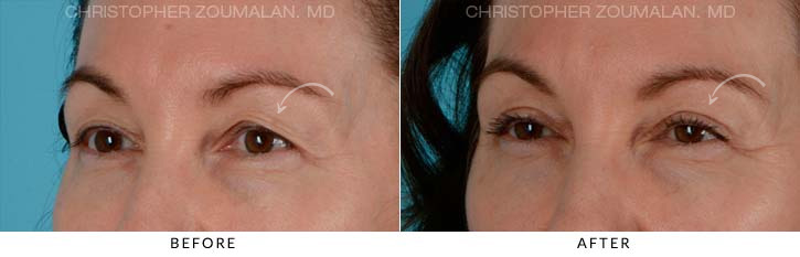 Upper Lid Blepharoplasty Before & After Photo - Patient Seeing side - Patient 17B