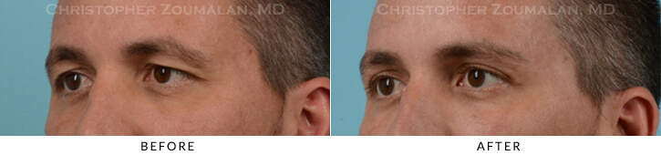 Upper Lid Blepharoplasty Before & After Photo - Patient Seeing Side - Patient 35B