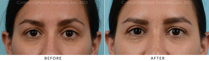 Upper Lid Blepharoplasty Before & After Photo -  - Patient 36