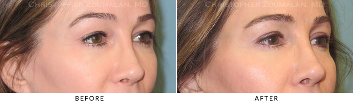 Upper Lid Blepharoplasty Before & After Photo - Patient Seeing Side - Patient 37C