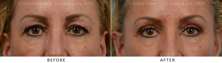 Upper Lid Blepharoplasty Before & After Photo -  - Patient 41