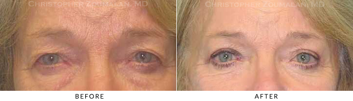 Upper Lid Blepharoplasty Before & After Photo -  - Patient 43