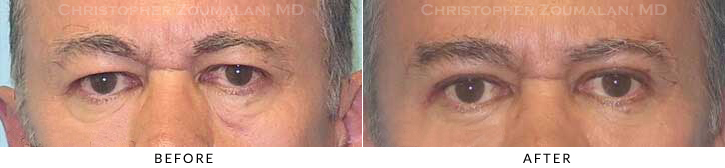 Upper Lid Blepharoplasty Before & After Photo - Patient Seeing Straight - Patient 44A