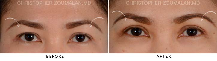 Upper Lid Blepharoplasty Before & After Photo - Patient Seeing Straight - Patient 18