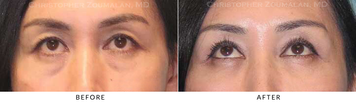 Upper Lid Blepharoplasty Before & After Photo - Patient Seeing Up - Patient 45C