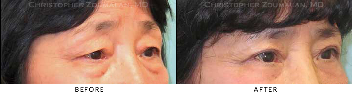 Upper Lid Blepharoplasty Before & After Photo - Patient Seeing Side - Patient 47A