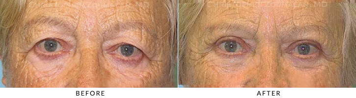 Upper Lid Blepharoplasty Before & After Photo -  - Patient 48