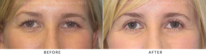 Upper Lid Blepharoplasty Before & After Photo -  - Patient 50