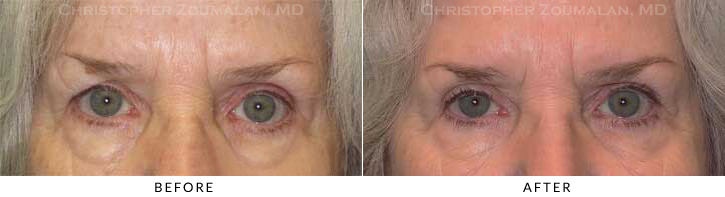 Upper Lid Blepharoplasty Before & After Photo -  - Patient 52