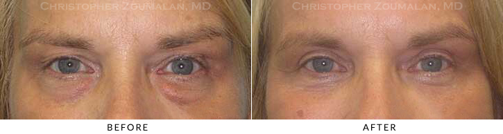 Upper Lid Blepharoplasty Before & After Photo - Patient Seeing Straight - Patient 54A