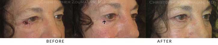 Eyelid Skin Cancer Excision Before & After Photo - Patient Seeing Side - Patient 3