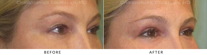 Upper Lid Blepharoplasty Before & After Photo - Patient Seeing Side - Patient 57B