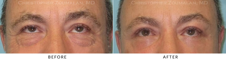 Upper Lid Blepharoplasty Before & After Photo -  - Patient 59C