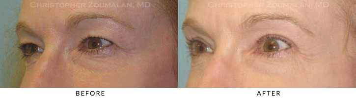 Upper Lid Blepharoplasty Before & After Photo - Patient Seeing Side - Patient 60A