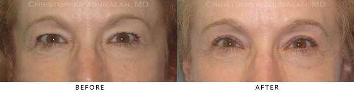 Upper Lid Blepharoplasty Before & After Photo - Patient Seeing Straight - Patient 60B