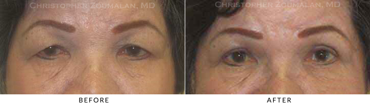 Upper Lid Blepharoplasty Before & After Photo -  - Patient 61