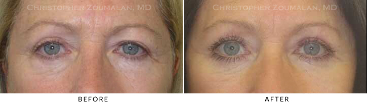 Upper Lid Blepharoplasty Before & After Photo -  - Patient 62