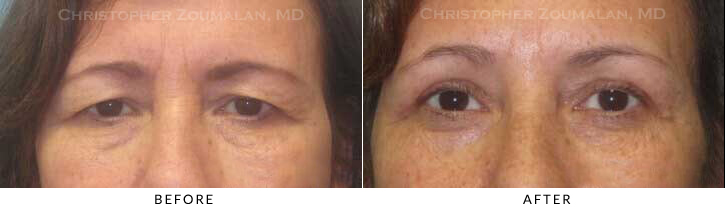 Upper Lid Blepharoplasty Before & After Photo -  - Patient 63