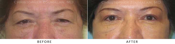 Upper Lid Blepharoplasty Before & After Photo -  - Patient 64