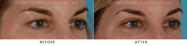 Upper Lid Blepharoplasty Before & After Photo - Patient Seeing Side - Patient 20B