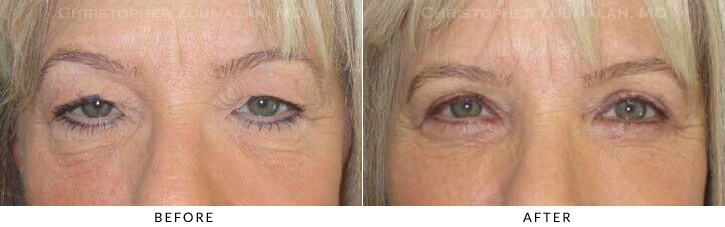 Upper Lid Blepharoplasty Before & After Photo -  - Patient 65