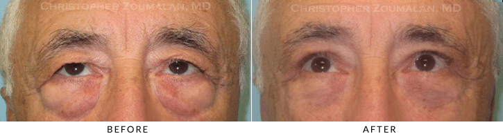 Upper Lid Blepharoplasty Before & After Photo - Patient Seeing Up - Patient 68A