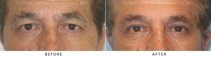 Upper Lid Blepharoplasty Before & After Photo -  - Patient 70