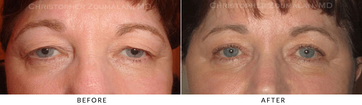 Upper Lid Blepharoplasty Before & After Photo -  - Patient 73
