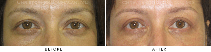 Upper Lid Blepharoplasty Before & After Photo -  - Patient 74