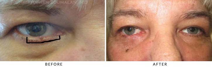 Eyelid Skin Cancer Excision Before & After Photo - Patient Seeing Straight - Patient 5