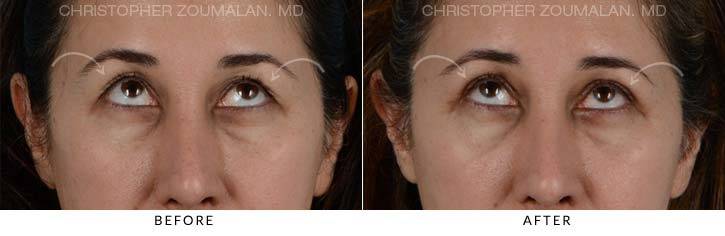 Upper Lid Blepharoplasty Before & After Photo - Patient Seeing Up - Patient 21C