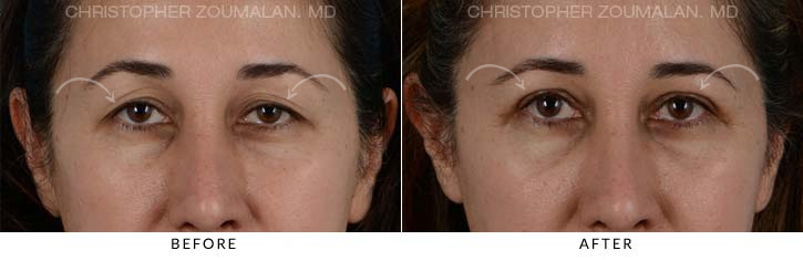 Upper Lid Blepharoplasty Before & After Photo - Patient Seeing Straight - Patient 21D