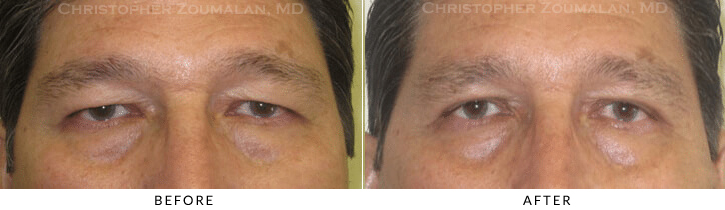 Upper Lid Blepharoplasty Before & After Photo -  - Patient 75