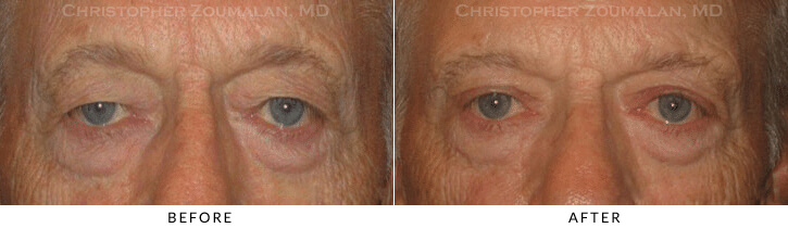 Upper Lid Blepharoplasty Before & After Photo -  - Patient 77