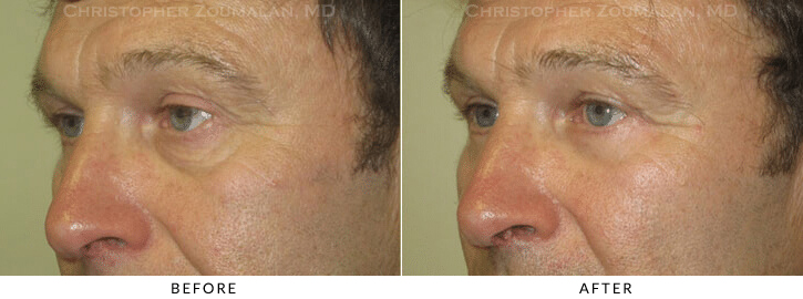 Upper Lid Blepharoplasty Before & After Photo -  - Patient 80