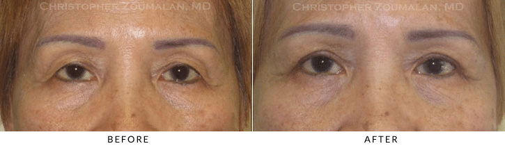 Upper Lid Blepharoplasty Before & After Photo -  - Patient 82