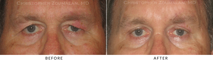 Upper Lid Blepharoplasty Before & After Photo -  - Patient 81