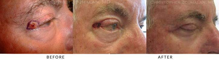 Eyelid Skin Cancer Excision Before & After Photo - Patient Seeing Side - Patient 6