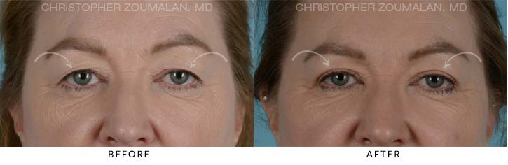 Upper Lid Blepharoplasty Before & After Photo - Patient Seeing Straight - Patient 22C