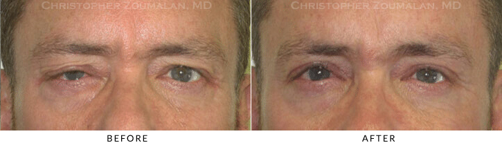 Upper Lid Blepharoplasty Before & After Photo -  - Patient 88