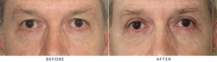 Upper Lid Blepharoplasty Before & After Photo -  - Patient 89
