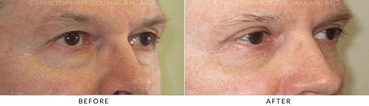 Upper Lid Blepharoplasty Before & After Photo -  - Patient 90