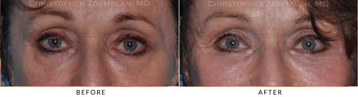 Upper Lid Blepharoplasty Before & After Photo -  - Patient 93