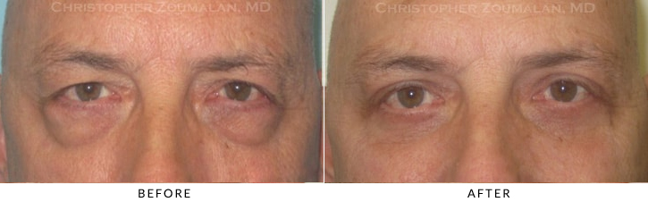 Upper Lid Blepharoplasty Before & After Photo -  - Patient 94