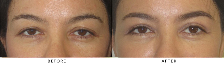 Upper Lid Blepharoplasty Before & After Photo -  - Patient 97